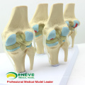 JOINT12 (12359) Medical Anatomy Model 4-Stage Osteoarthritis Knee Joint Models